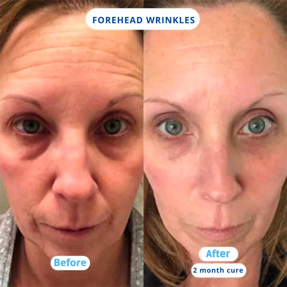 Nuvea Care MicroNeedling set Microneedle Infusion Anti - Aging Solution - Nuvea care