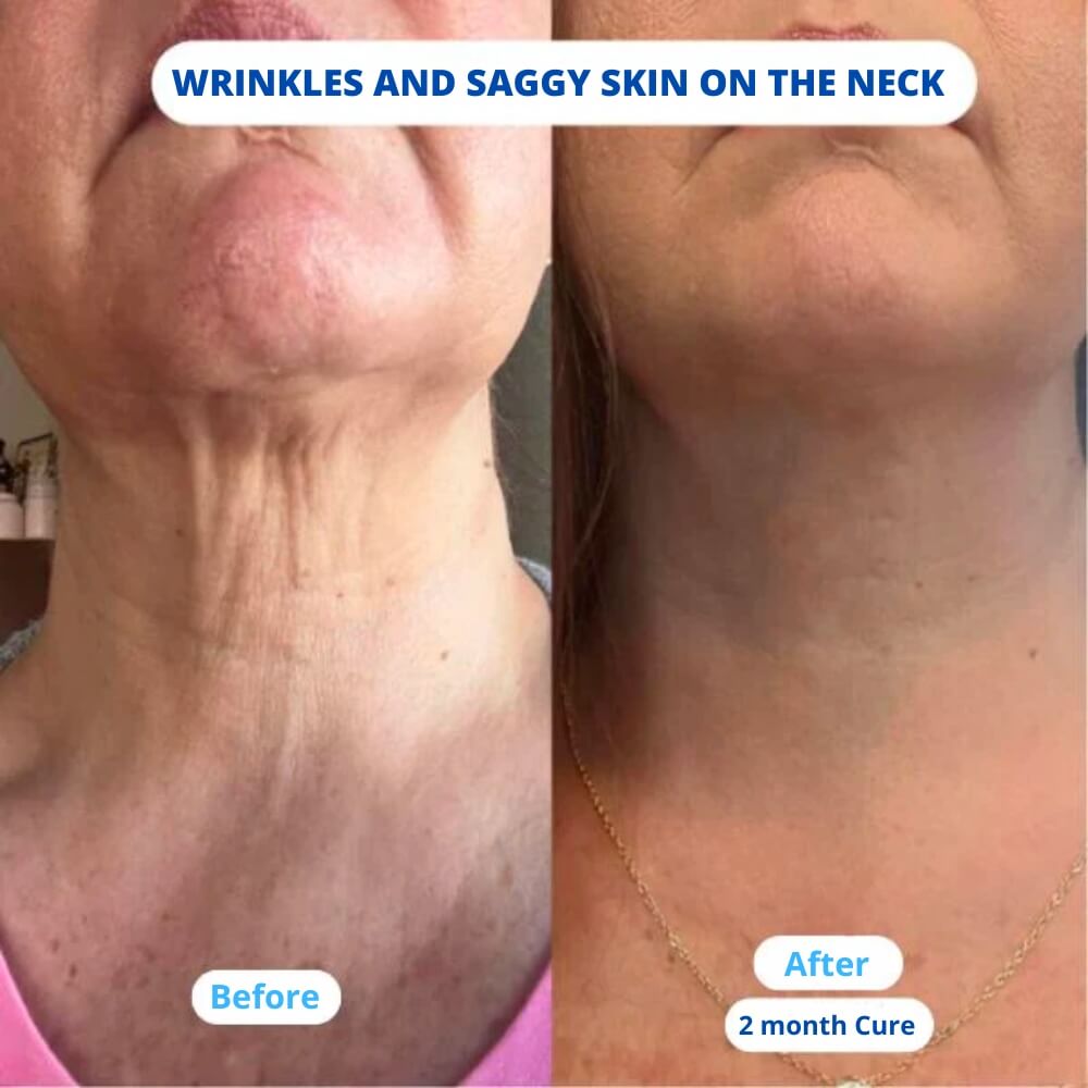 Nuvea Care MicroNeedling set Microneedle Infusion Anti - Aging Solution - Nuvea care