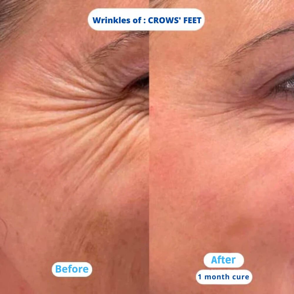 Nuvea Care MicroNeedling set Microneedle Infusion Anti - Aging Solution - Nuvea care