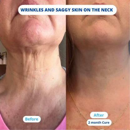 Nuvea Care MicroNeedling set Microneedle Infusion Anti - Aging Solution - Nuvea care