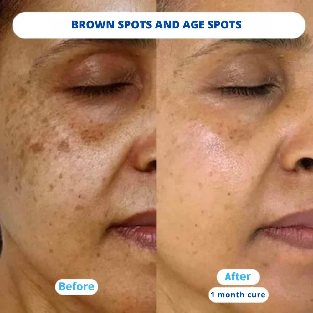 NUVEA CARE MicroNeedling set Microneedle Infusion Anti - Aging Solution - Nuvea care