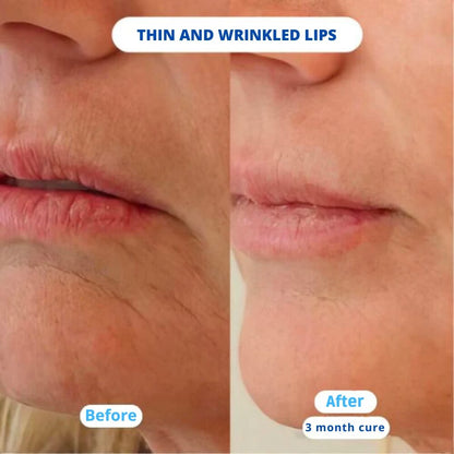 NUVEA CARE MicroNeedling set Microneedle Infusion Anti - Aging Solution - Nuvea care